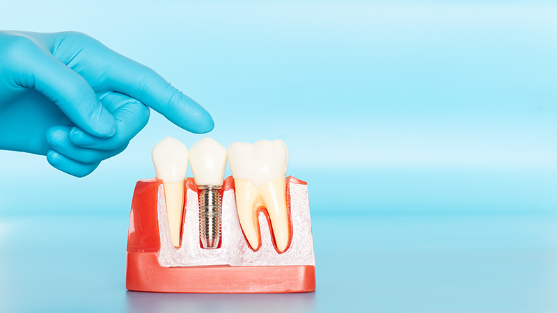Life Smiles Dentistry -Will It Hurt to Get a Dental Implant?